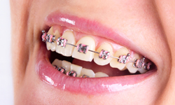 Braces - Orthodontist Montreal QC